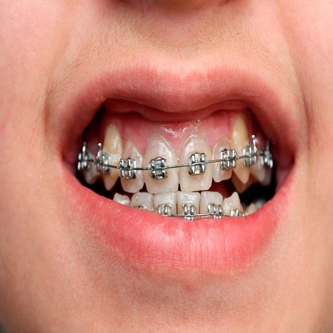 NZa beboet tandprotheticus voor toeslag gebitsprotheses